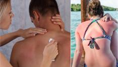 Слънчево изгаряне – 5 домашни средства, с които да успокоите кожата