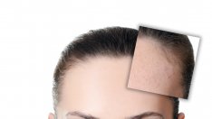 8-те най-чести причини за акне след пубертета