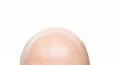 Гравитацията причинява оплешивяване