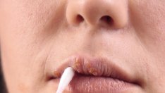 Домашни средства за справяне с херпеса