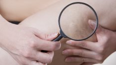 5 признака на кръвен съсирек