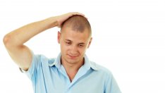 Защо мъжете оплешивяват през 20-те си години