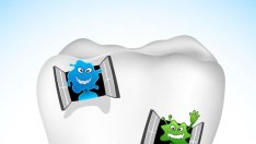 Японци създадоха защита срещу кариеси