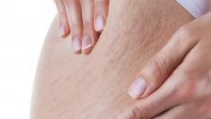 Помощ! Имам стрии!