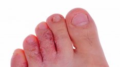 Гъбичната инфекция "атлетно стъпало"