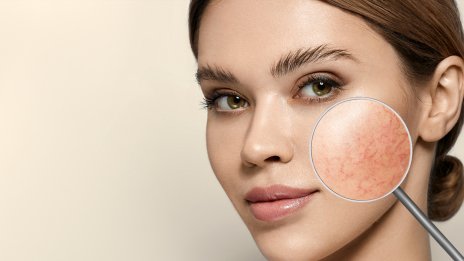 Грижа за кожата при розацея – 6 стъпки за по-спокойно лице