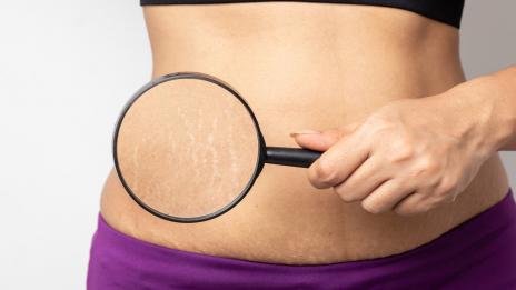 Стрии: Как да се отървем от тях и как да предотвратим появата им?