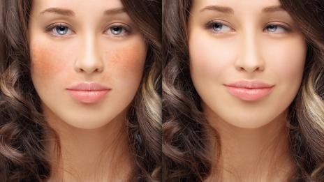 Хиперпигментация: Как да победите проблема?