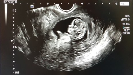 Фенове към Азис: Чакаш ли бебе?