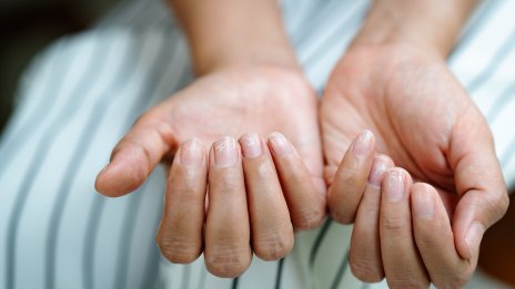 Хребети по ноктите – как да ги лекувате и заличите