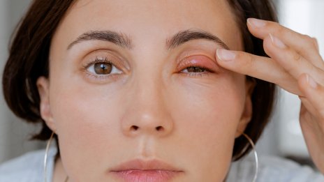 Кожата на клепачите ви е червена и ви сърби? Може би имате дерматит