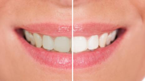 5 домашни трика за по-бели зъби