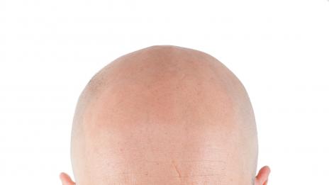 Нова „вампирска“ терапия лекува плешивост