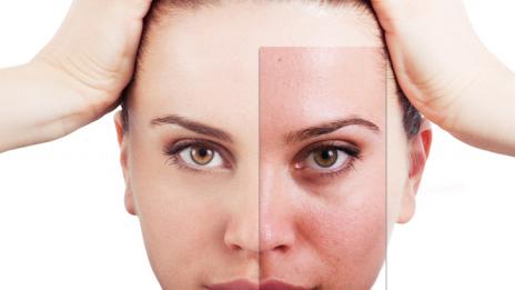 Имате раздразнена кожа?