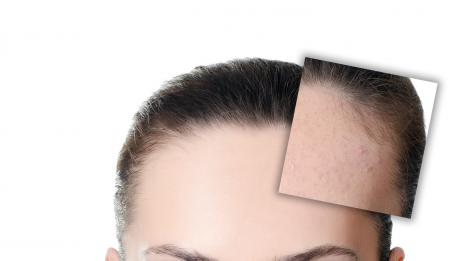 8-те най-чести причини за акне след пубертета