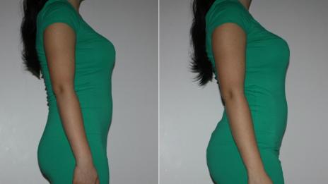 Д-р Йорданов: Операцията за бразилско дупе крие много рискове