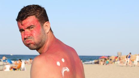 Алое, кисело мляко... Какво помага при изгаряне?