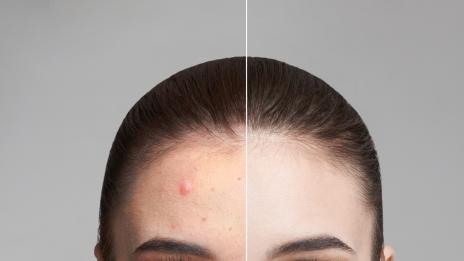 4 средства за лекуване на пъпки през нощта