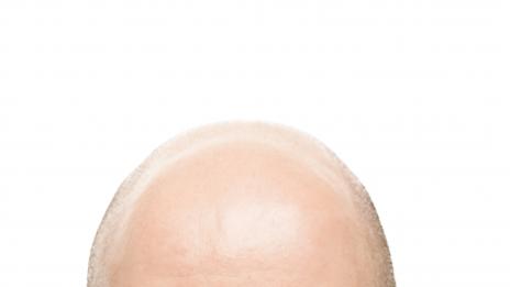 Терапия със стволови клетки лекува плешивостта