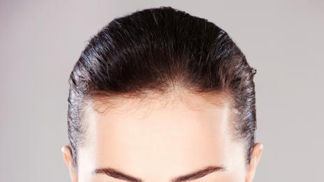 Хирургично лепило измества шевовете на клепачите