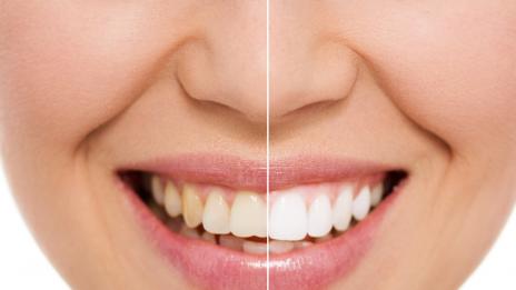 Сияйна усмивка – как да я постигнете с натурални средства?