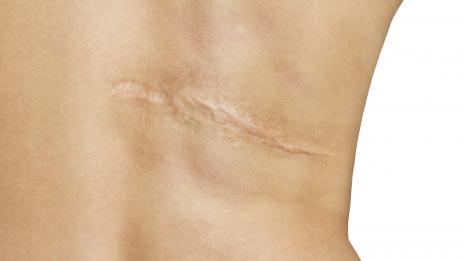 Как да се избавим от белезите с домашни средства?