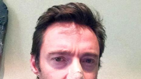 Хю Джакман е диагностициран с рак на кожата