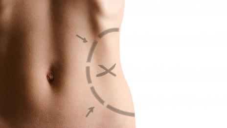 Липосукцията - нож с две остриета