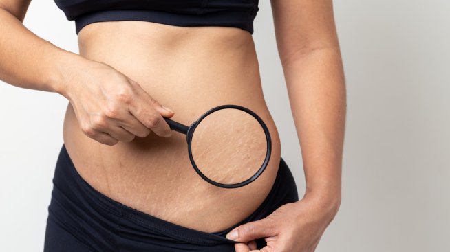 Как лесно да премахнем стриите в домашни условия