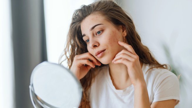 Белези от акне – как да ги премахнете веднъж завинаги