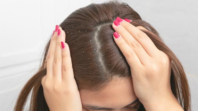 5 домашни трика за борба с пърхота
