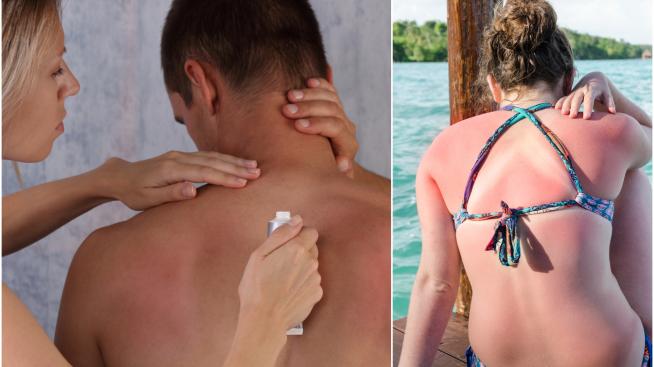 Слънчево изгаряне – 5 домашни средства, с които да успокоите кожата