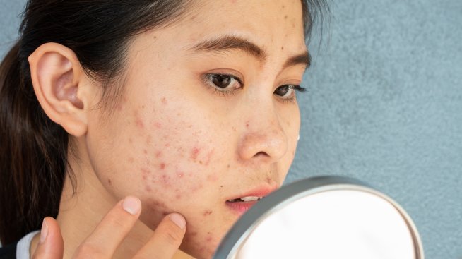 Картография на лицето – какво показват пъпките за здравето ви