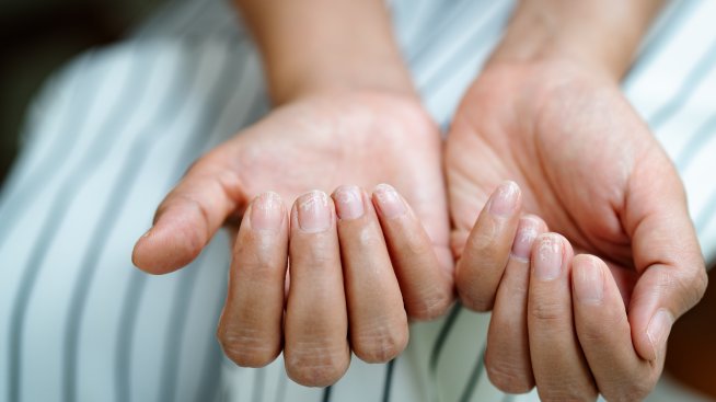 Хребети по ноктите – как да ги лекувате и заличите