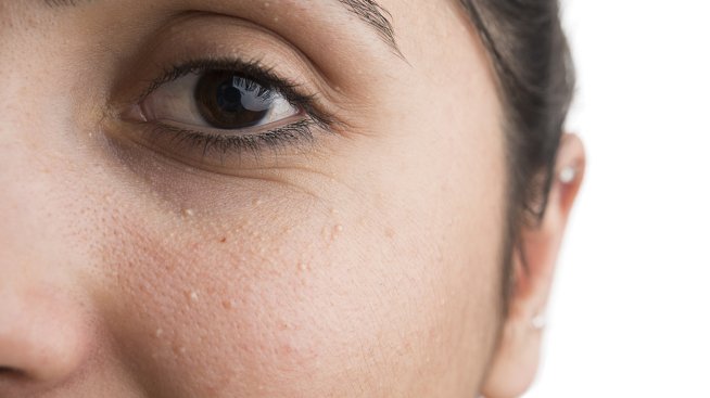 Милиум - как да се справим с досадните бели точки?