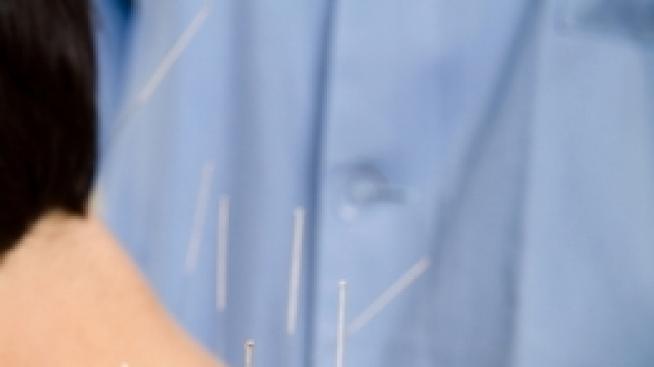 Акупунктура вместо обезболяващи