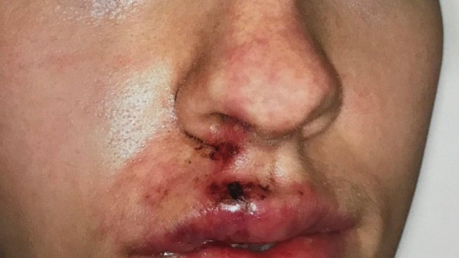 Ниска цена и мними спецове: Ботоксът и филърите могат да ви обезобразят!