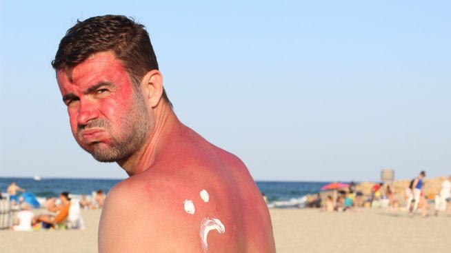 Алое, кисело мляко... Какво помага при изгаряне?