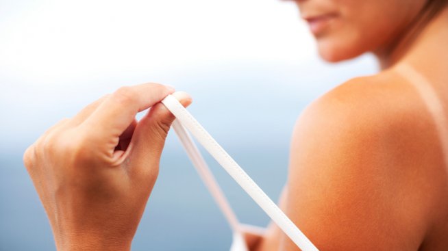 Как да се отървем от белеща се кожа след изгаряне?