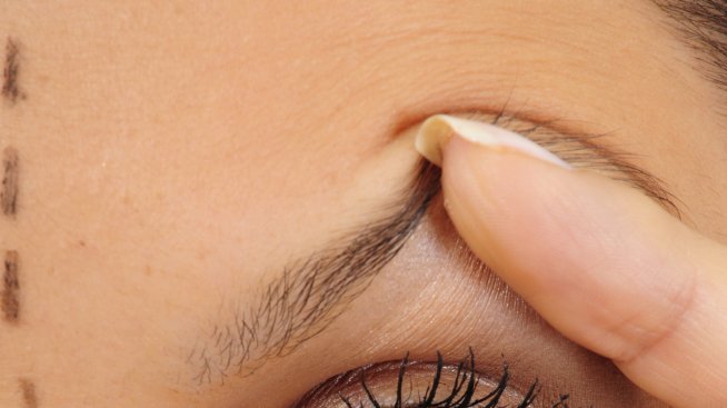 Блефаропластика за по-красиви очи