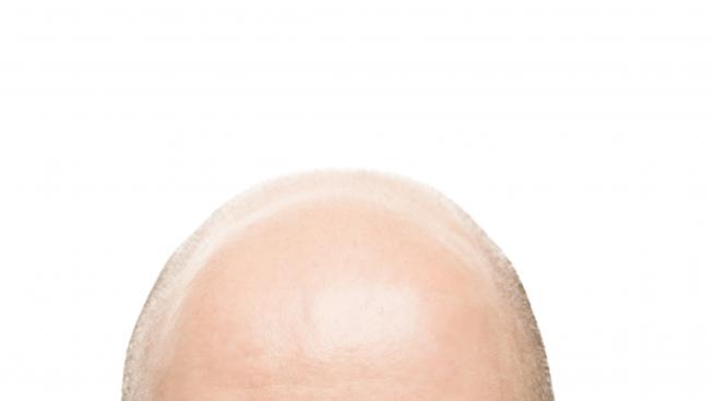 Терапия със стволови клетки лекува плешивостта