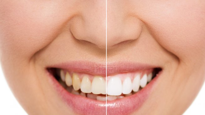 Сияйна усмивка – как да я постигнете с натурални средства?