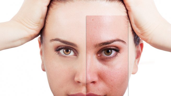 Въздействието на стреса върху кожата