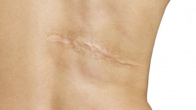 Как да се избавим от белезите с домашни средства?