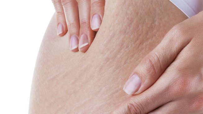 Помощ! Имам стрии!