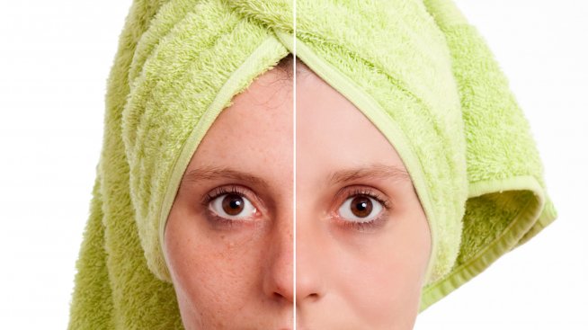 Вируси помагат в борбата с акнето