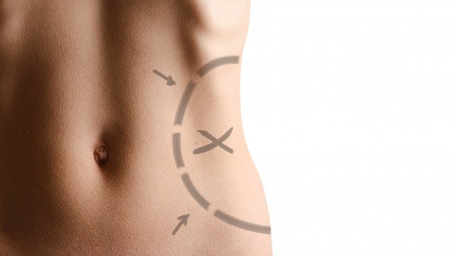 Липосукцията - нож с две остриета